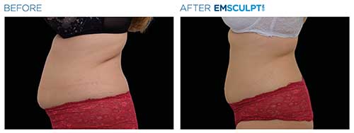 Dr. Isom before after images with Emsculpt Neo